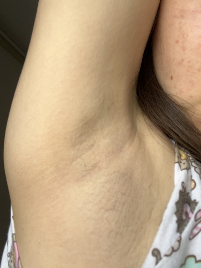 This is my underarms after using IPL device for 2 years