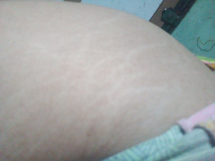 Why do I have so many stretch marks? Im only 17?