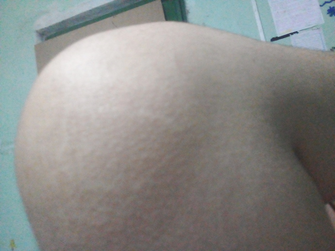 Why do I have so many stretch marks? Im only 17?