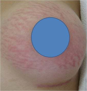 Why do I have so many stretch marks? I'm only 17?