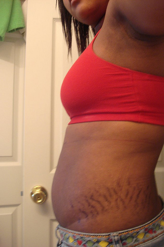 Why do I have so many stretch marks? I'm only 17?