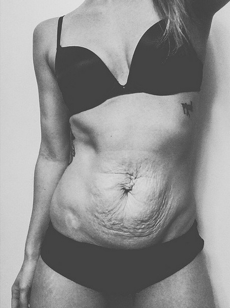 Why do I have so many stretch marks? I'm only 17?