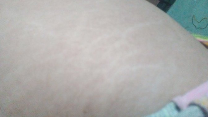 Why do I have so many stretch marks? I'm only 17?