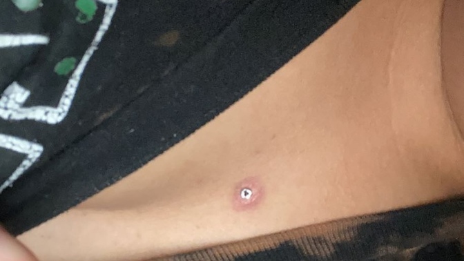 I just got my dermal piercing a few days ago. it’s not swollen at all. so I’m wondering if this is the healing process or not? it’s not a bump but?
