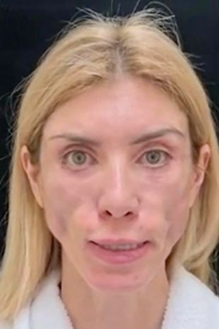 Woman looks like a Zombie after plastic surgery?