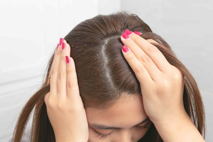 Do you get dandruff easily?