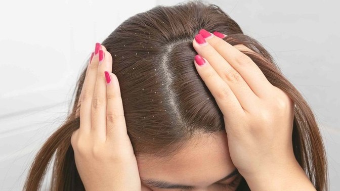 Do you get dandruff easily?