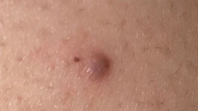 I have this bump on my ass is it a ingrown hair (pic)?