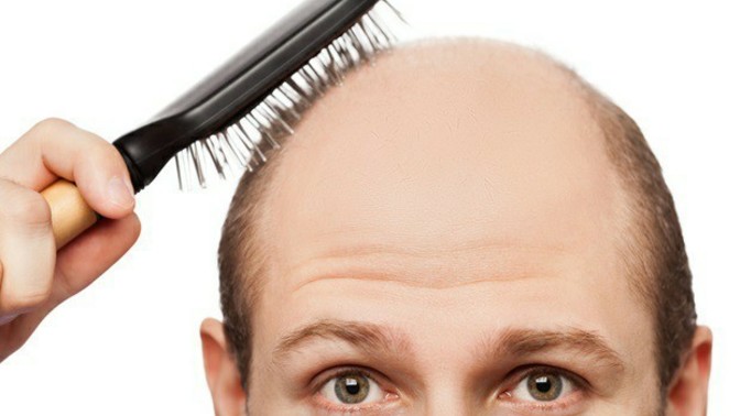 Guys: Are you afraid of losing all of your hair?