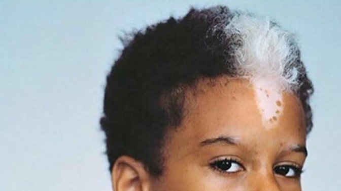 What do you think of a Mallen streak birthmark?