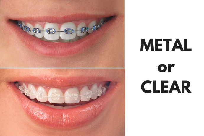 Whats your opinion about braces? Are they unattractive?