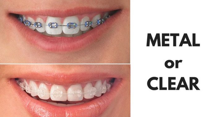 What's your opinion about braces? Are they unattractive?