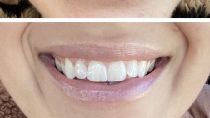 Girls, have any of you had a 'lip flip' procedure?