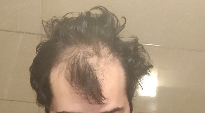 Should I wear hats or should I shave my head?