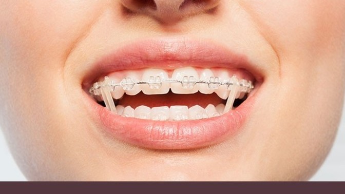 Removing rubber bands from braces in public. Norm or gross?