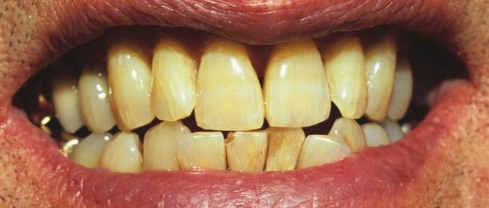 If a person looks attractive from head to toe, but their teeth, although straight, were a bit on the yellow side, Would that change your view?