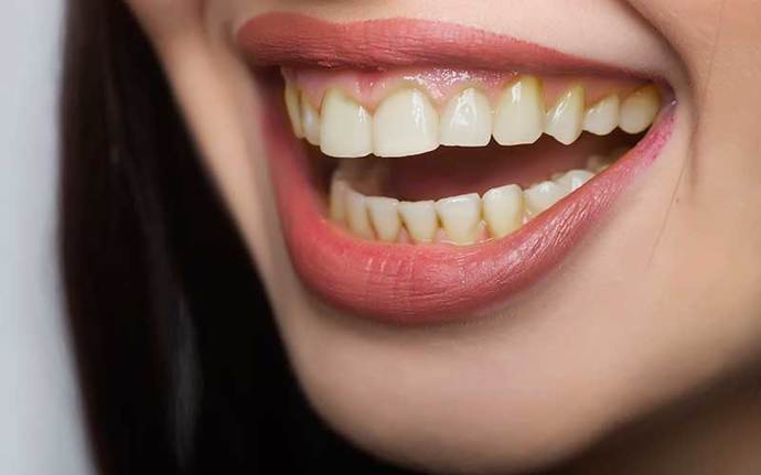 If a person looks attractive from head to toe, but their teeth, although straight, were a bit on the yellow side, Would that change your view?