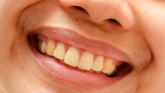 If a person looks attractive from head to toe, but their teeth, although straight, were a bit on the yellow side, Would that change your view?