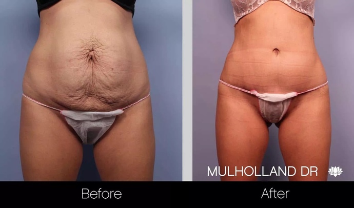 How do you feel about a woman getting a tummy tuck?