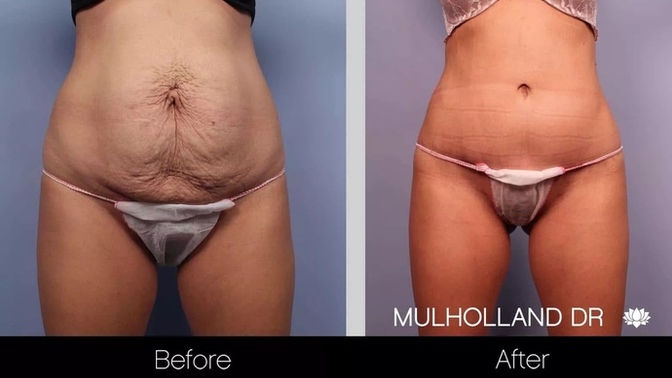 How do you feel about a woman getting a tummy tuck?