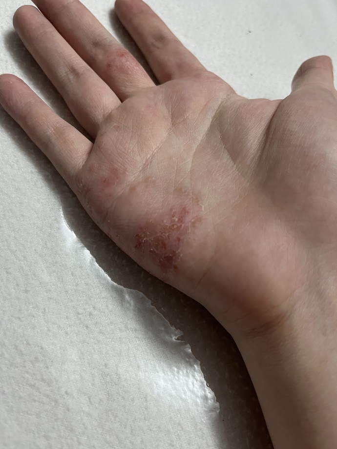 This will probably stop you from scratching and peeling