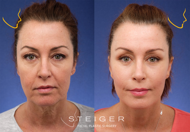 Why are guys against their partner getting plastic surgery even if the results are good?