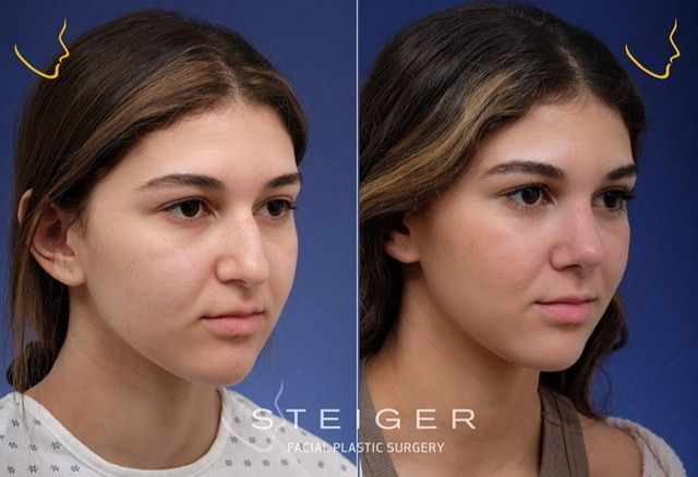 Why are guys against their partner getting plastic surgery even if the results are good?