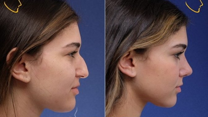 Why are guys against their partner getting plastic surgery even if the results are good?