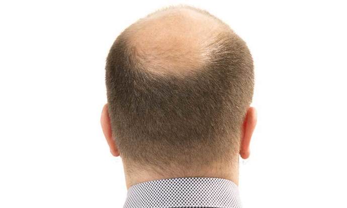 If your partner was balding, would you encourage them to cut it all off?