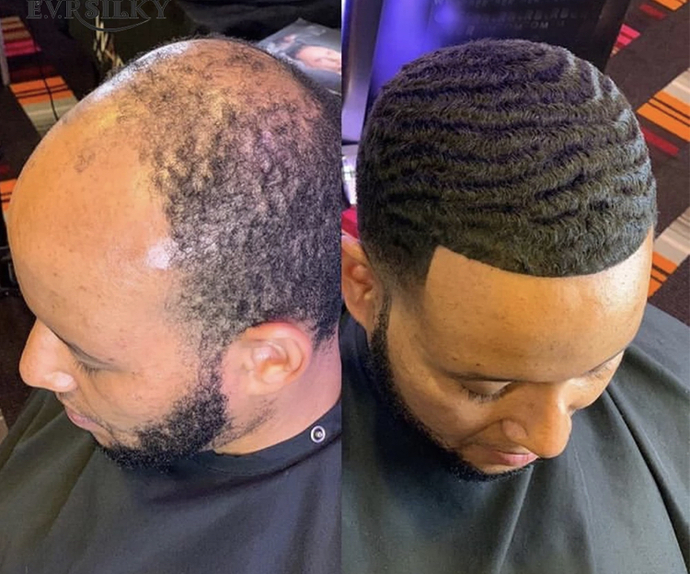 If your partner was balding, would you encourage them to cut it all off?