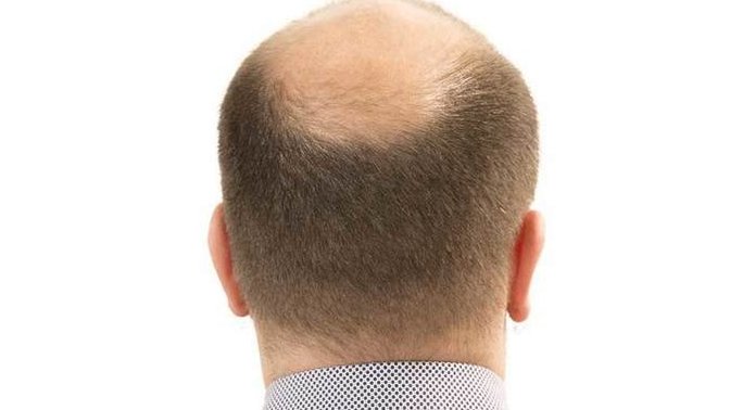 If your partner was balding, would you encourage them to cut it all off?