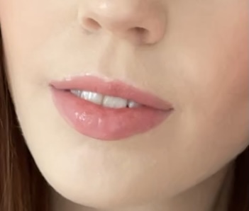 Should I consider lip injections?