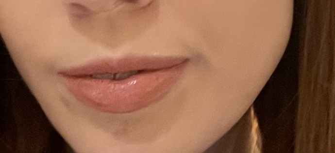 Should I consider lip injections?