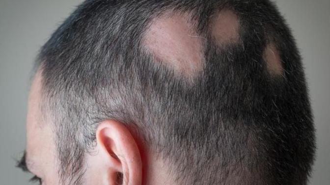 What is alopecia? How to detect it?