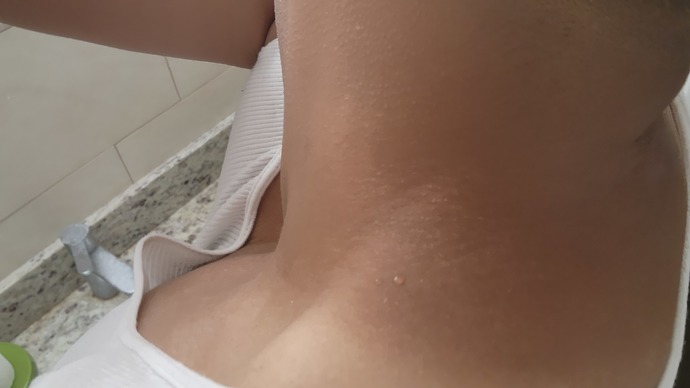 How long til my natural skin color comes back around my neck area or heal?
