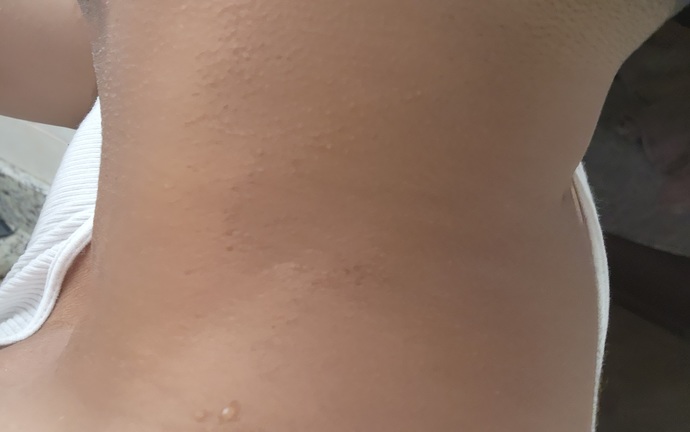 How long til my natural skin color comes back around my neck area or heal?