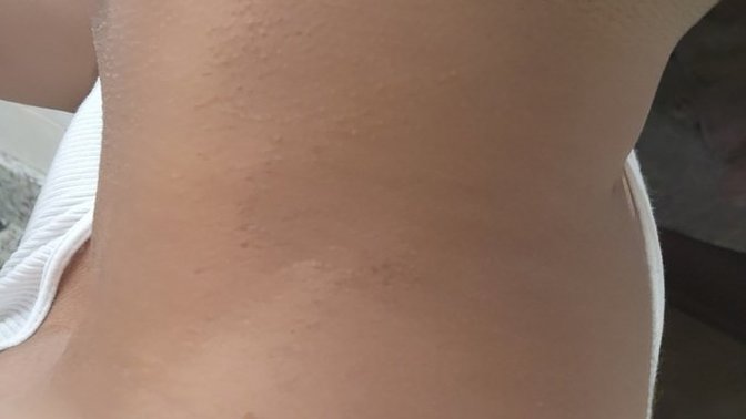 How long til my natural skin color comes back around my neck area or heal?