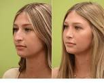 Are nose jobs worth it?