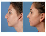 Are nose jobs worth it?
