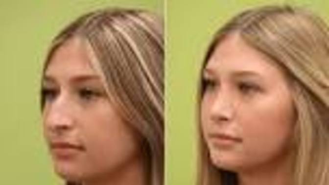 Are nose jobs worth it?