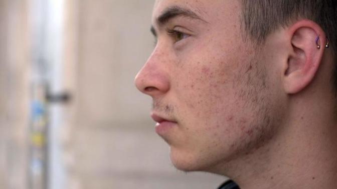 How do you avoid acne in the Summer?