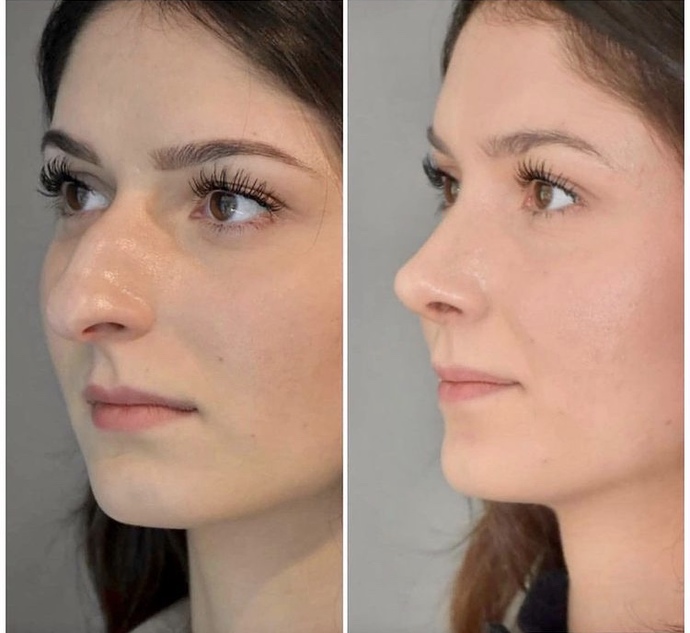 Guys, would you still date this girl before she had a nose job?