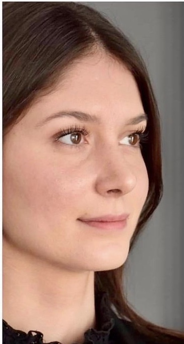 Guys, would you still date this girl before she had a nose job?