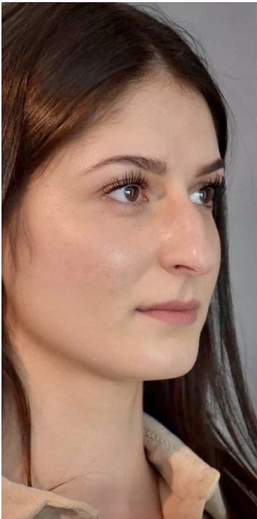 Guys, would you still date this girl before she had a nose job?