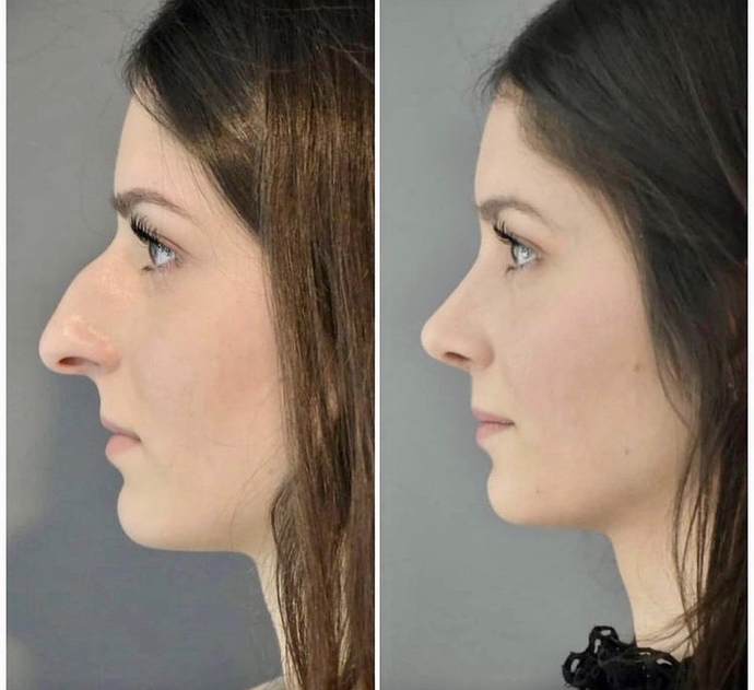 Guys, would you still date this girl before she had a nose job?