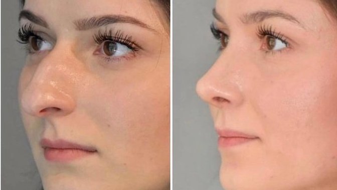 Guys, would you still date this girl before she had a nose job?