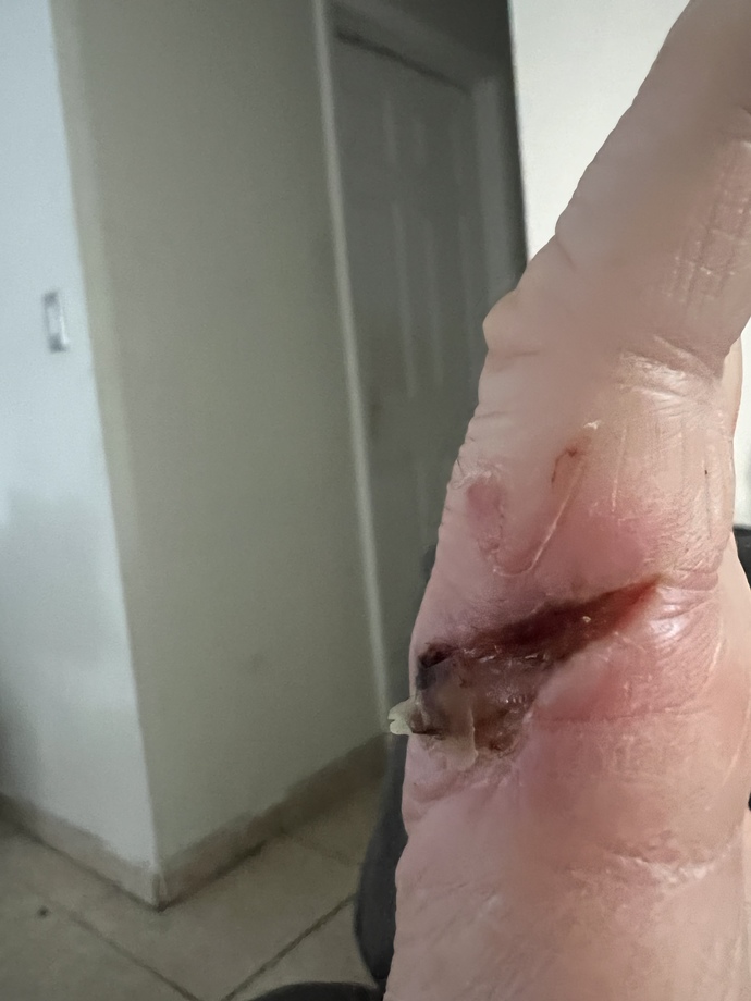 Should I GO hospital or something for my foot feet accident injury I had?