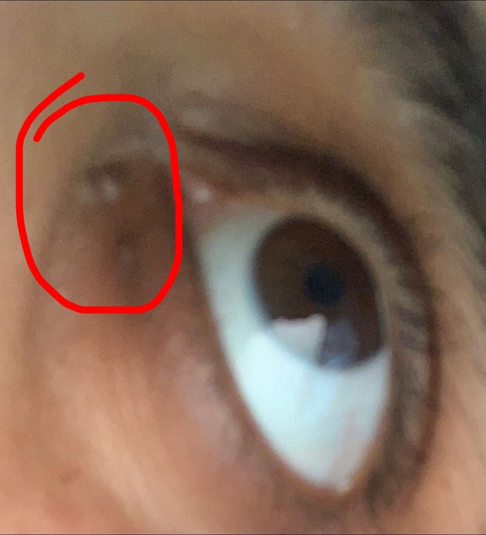 Why Is There A Spot Under Eye In Corner?