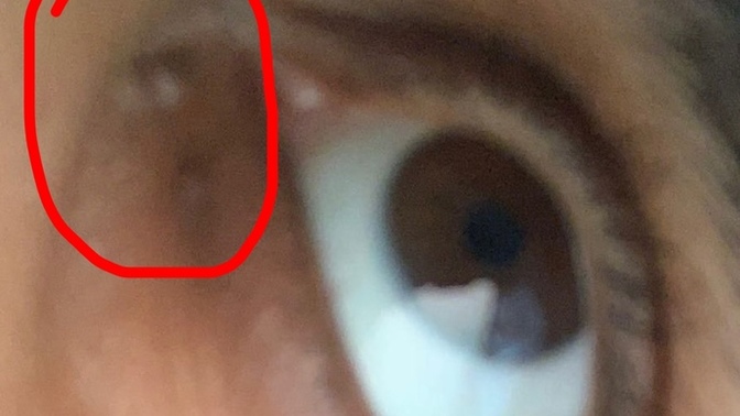 Why Is There A Spot Under Eye In Corner?