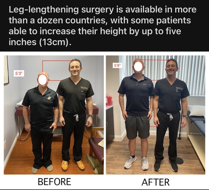 Would you get leg lengthening surgery if you had the chance?